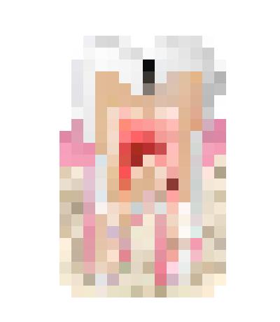root_canal